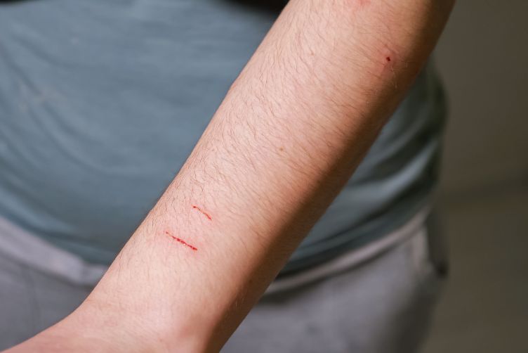 Bị mèo cào có sao không