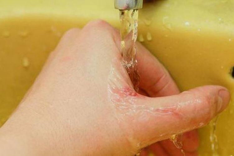 Bị mèo cào có sao không